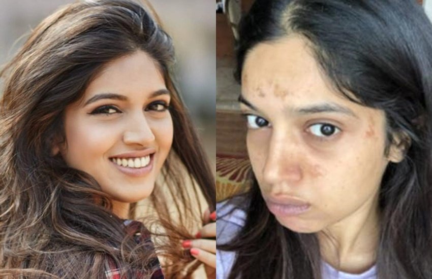प्रोस्थेटिक के कारण भूमि का चेहरे पर फफोले पड़ गए हैं।