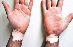 सफेद दाग से हैं परेशान और करना चाहते हैं दूर तो आजमा कर देखें ये उपाय