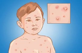 chicken pox, choti mata, why people call choti mata, why chicken pox name is choti mata, why people call chicken pox choti mata, choti mata kya hai, mata ka ana, छोटी माता, चिकन पॉक्स को क्यों कहा जाता है छोटी माता,