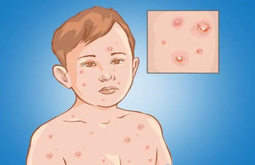 chicken pox, choti mata, why people call choti mata, why chicken pox name is choti mata, why people call chicken pox choti mata, choti mata kya hai, mata ka ana, छोटी माता, चिकन पॉक्स को क्यों कहा जाता है छोटी माता,