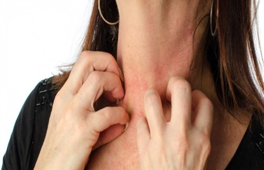 एक्जिमा (Image for representational purpose only)