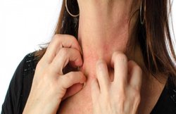 एक्जिमा के मरीज इन फूड्स को जरूर करें डाइट में शामिल