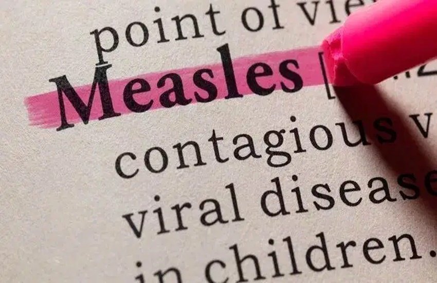Measles, measles treatment, measles home remedies, measles in adults, measles pictures, measles causes, measles symptoms, measles in babies, measles treatment and prevention, measles meaning, measles diagnosis, measles disease in hindi