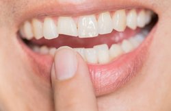 Teeth Whitening: दांतों के पीलेपन से पाना चाहते हैं छुटकारा, तो बेकिंग सोडा का करें इस्तेमाल