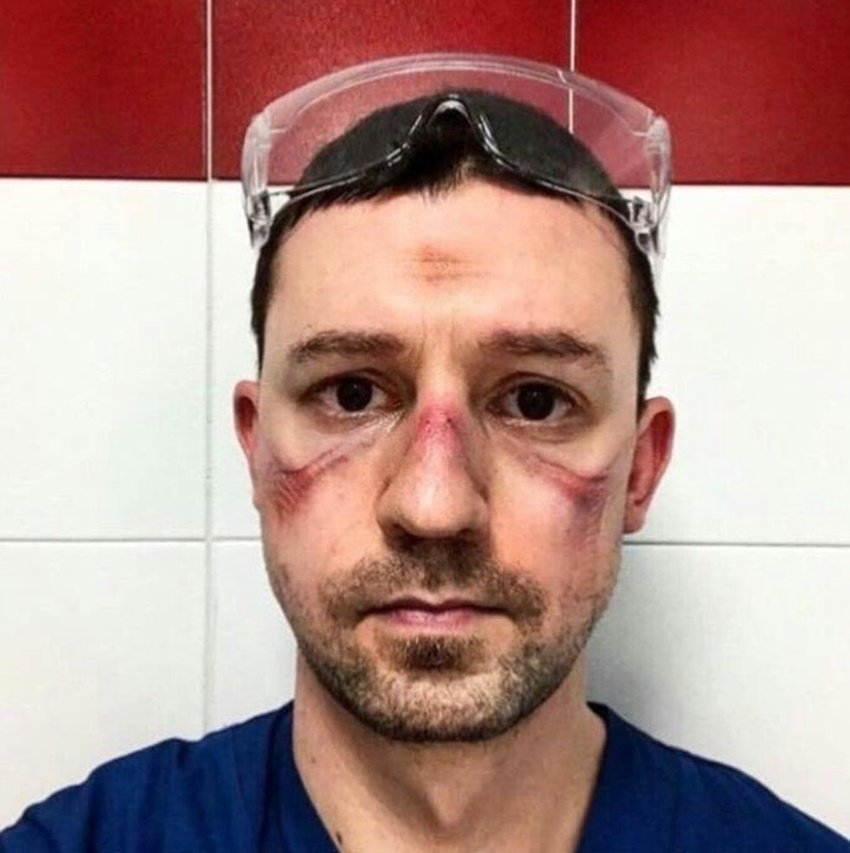 मास्क के कारण चेहरे पर खून जम गया है। ये निशान मास्क से रगड़ खा-खा कर जख्म बन गए हैं।