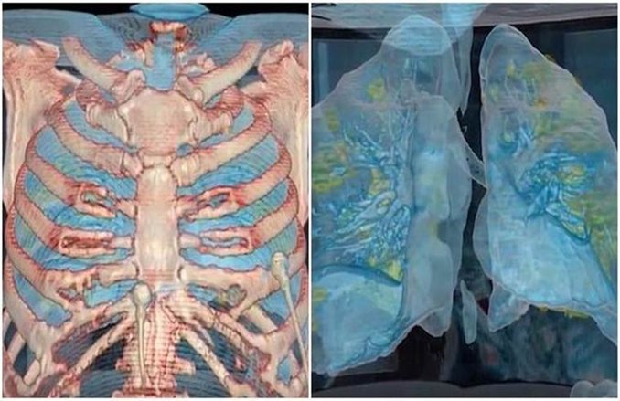 कोविड-19: 3D वीडियो में देखिए, कोरोना वायरस कैसे फेफड़े को पहुंचाता है नुकसान