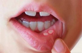 cancer risk, lip cancer, lip ulcer in people, cancer prevention, tips for cancer patients