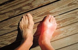 Uric Acid, uric acid symptoms, gout, arthritis, uric acid causes, uric acid remedy