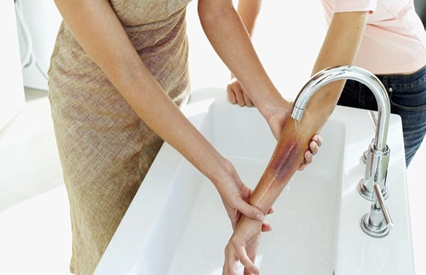 burn remedies, burn home remedies, how to treat burns, tips to treat burns, what to do after burning skin, what to do after burning while cooking, jalne par gharelu nuskha, jalne par kya lagaaye, jalne par medicine, jalne par kya upchaar karna chahiye, jalne par kya kare, jalne par kya lagaye, jalne par na kare ye kaam, burn medicine, burn treatment burn remedies, burn home remedies, how to treat burns, tips to treat burns, what to do after burning skin, what to do after burning while cooking, jalne par gharelu nuskha, jalne par kya lagaaye, jalne par medicine, jalne par kya upchaar karna chahiye, jalne par kya kare, jalne par kya lagaye, jalne par na kare ye kaam, burn medicine, burn treatment