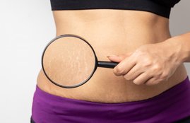 stretch marks, stretch marks during pregnancy, stretch marks treatment