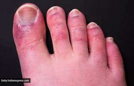 diabetes, diabetes symptoms, diabetes symptoms in leg, diabetes risk, blood sugar level, diabetes test