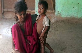 Hunger, Starvation. Malnutrition