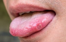 Mouth Ulcer: मुंह के छालों से हैं परेशान, इन 5 घरेलू उपायों से ऐसे मिलेगी राहत