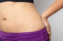 stretch marks, stretch marks removal, stretch marks removal cream, stretch marks kaise hataye