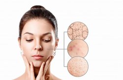 Skin Care: पिंपल्स की समस्या से हैं परेशान, तो भूलकर भी ना करें ये गलतियां, पड़ सकता है भारी