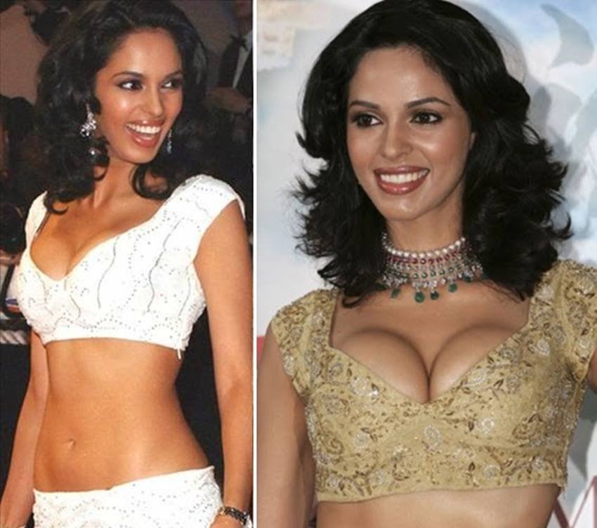 ब्रेस्ट एनलार्जमेंट सर्जरी करवाने वालों मे मल्लिका शेरावत का नाम भी शामिल हैं।