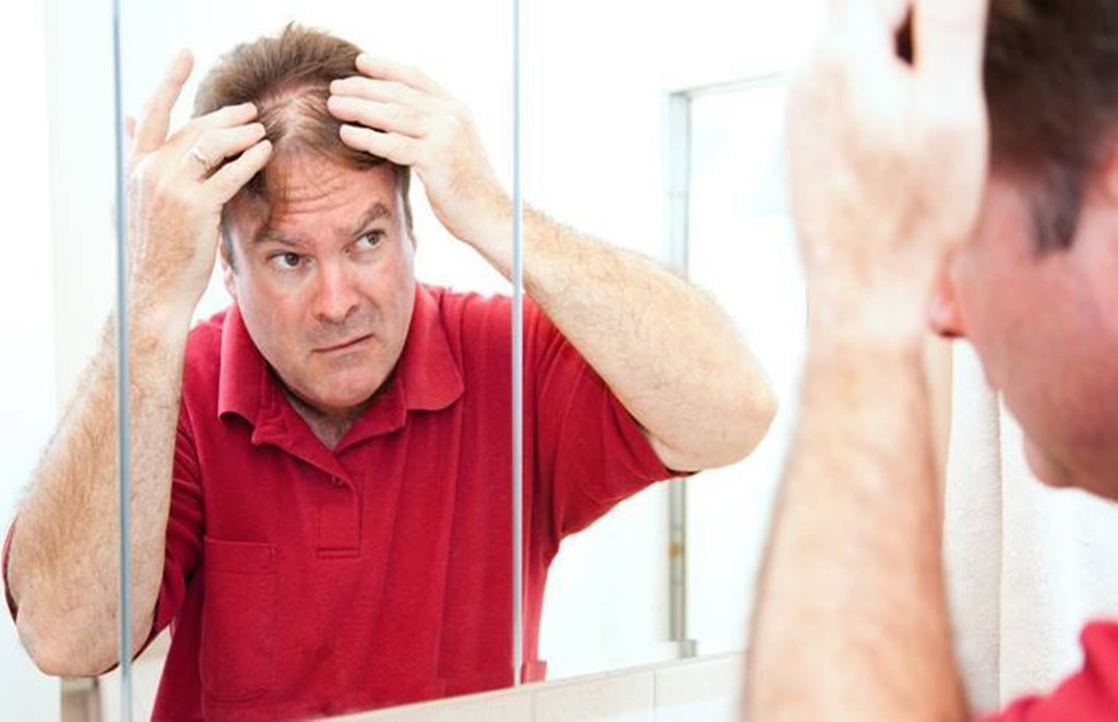 hair, hair problems, hair fall, hair fall, baldness, hair loss, dandruff, white hair