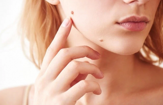home remedies for spotless face, easy home remedies to get rid of moles, easy home remedies to get rid of warts