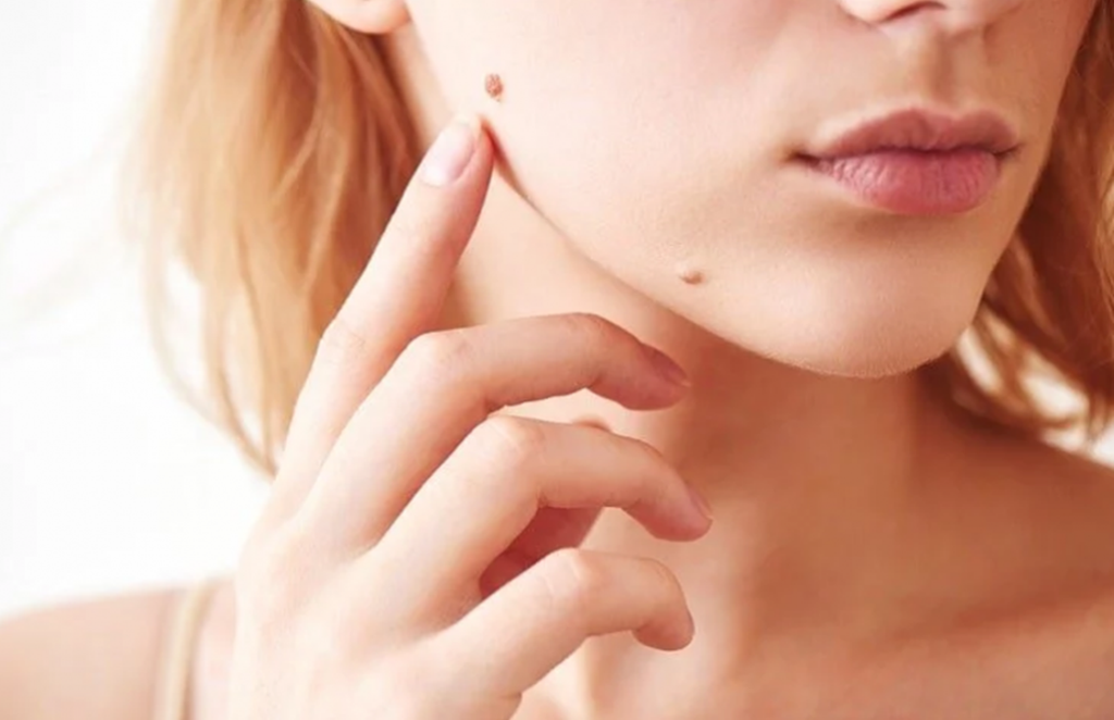 home remedies for spotless face, easy home remedies to get rid of moles, easy home remedies to get rid of warts