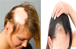 alopecia, treatment, natural remedies