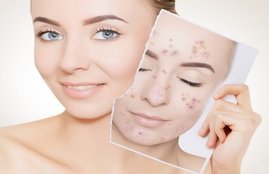 home remedy, pimple, pimple marks