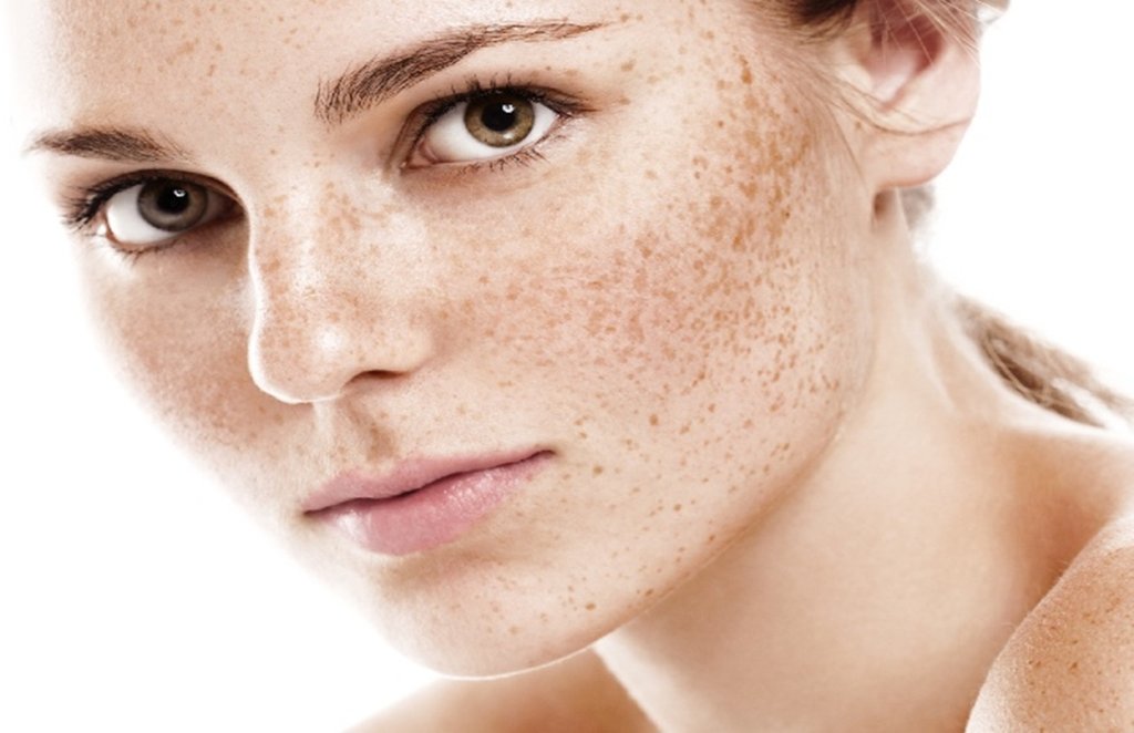skin pigmenatation home remedies, skin pigmentation home remedies, skin pigmentation home remedies in hindi