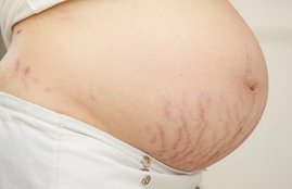 stretch marks, stretch marks removal oils, how to make stretch marks removal oils