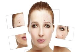 Skin Care, pimples, acne, dry skin, oily skin, eczema, psoriasis, blackheads, glowing skin