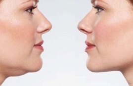 double chin, jawline, face fat