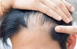 स्ट्रेस से लेकर स्मोकिंग तक, इन 5 कारणों से होने लगती है बाल झड़ने की समस्या, जानिये