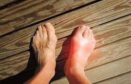 Uric Acid, Hyperuricemia, uric acid remedy, uric acid diet