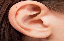 mole on ears, mole on ear, mole