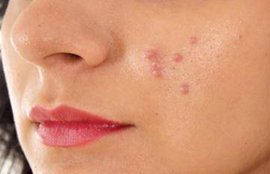 skincare, skincare tips in hindi, glowing skin, sugarcane juice for acne, pimples