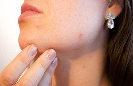 skincare, skincare tips in hindi, glowing skin, acne, pimples, what causes pimple, pimple remedies