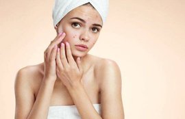 Forehead pimples, skincare, face pack, glowing skin, acne, pimples