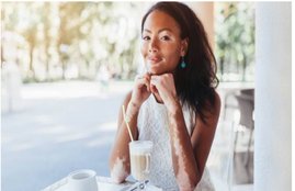 vitiligo, white spots, vitiligo tips