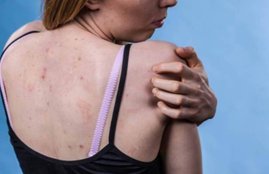 Acne On Back, Acne On Shoulder, Pimples
