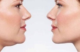facial fat, face fat, neck fat, facial fat removal