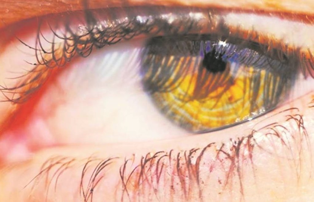 motiyabind, cataract surgery Cataract symptoms, मोतियाबिंद के लक्षण