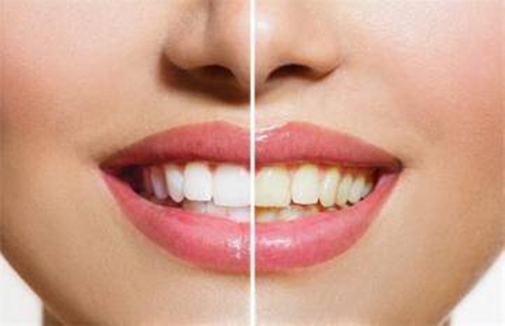 how to get white teeth, how to get rid of yellow teeth, teeth care tips