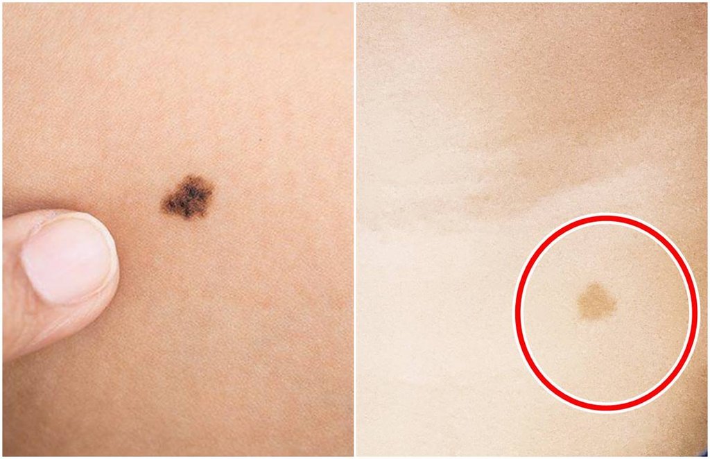 Birthmark, Birthmark on face, mole meaning, mole on face, samudra shastra,
