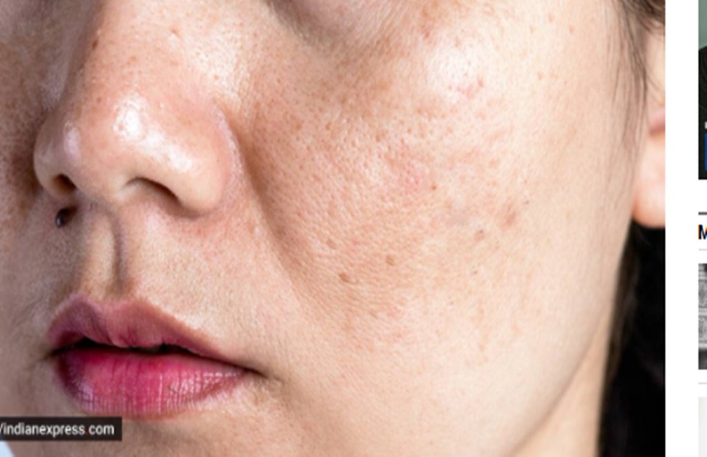 Skin Care, Open Pores, Tips For Open Pores
