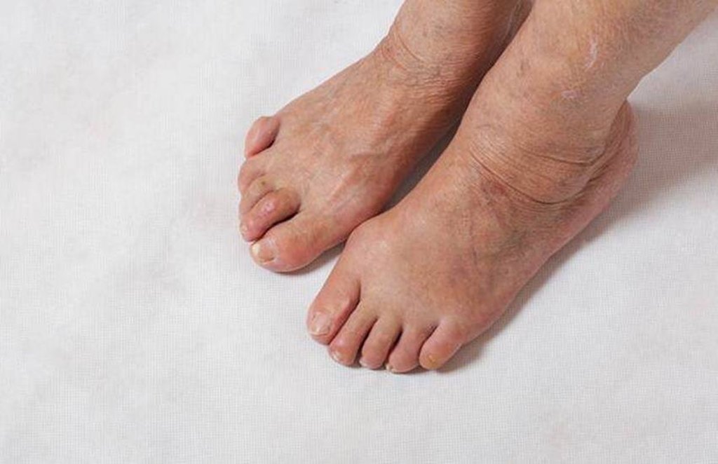 diabetes, diabetes symptoms, blood sugar level