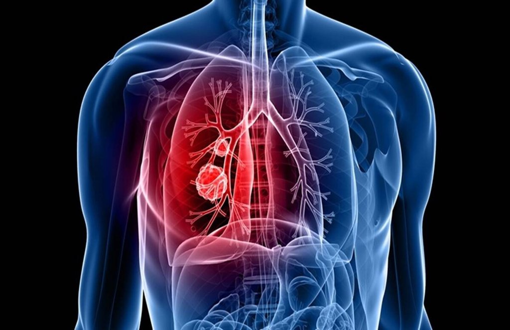 Coronavirus, healthy lungs, corona, covid 19, pneumonia