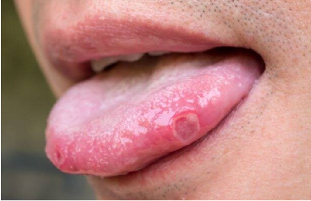 mouth ulcer, muh ke chale, home remedies for mouth ulcer