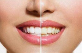 yellow teeth, teeth whitening, health tips