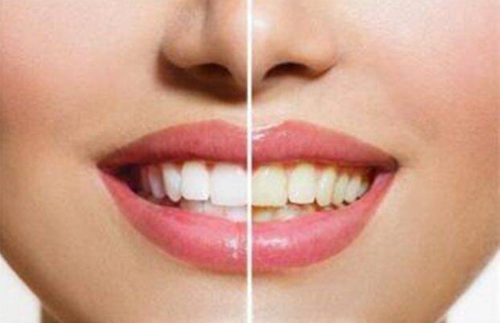 yellow teeth, teeth whitening, health tips