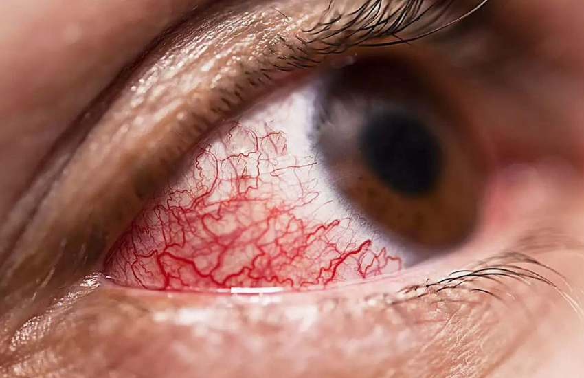 Corona Infection, Corona Sweet Avoidance