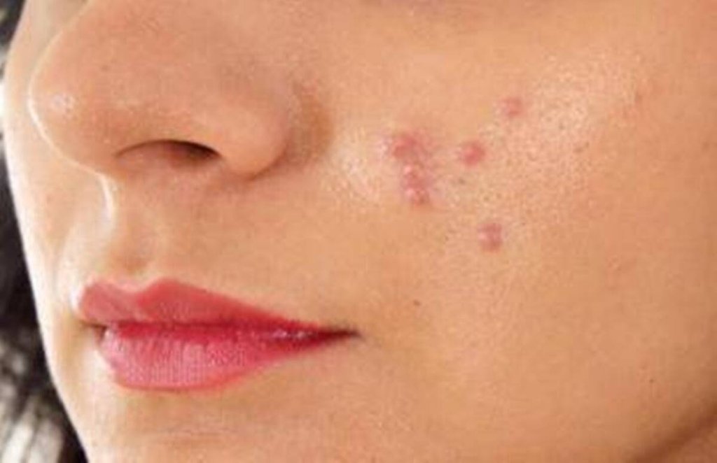 skin care, Skin Care Tips, pimples, summer skin care skin care, Skin Care Tips, pimples, summer skin care