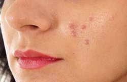 Skincare: इन फूड्स को खाने से कम हो सकती है पिंपल्स की परेशानी, जानिये